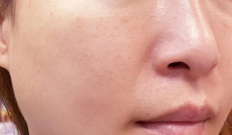 台北打皮秒│探索皮秒+蜂巢(超級鏡片ReFIX)-台北醫美診所推薦