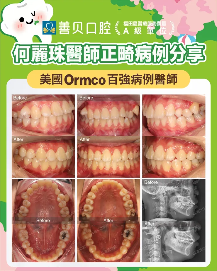 深圳善貝口腔自鎖托槽案例分享