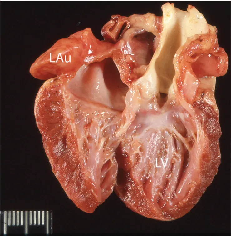 限制性心肌病，左心室心內膜變厚與纖維化變白，左心耳擴張