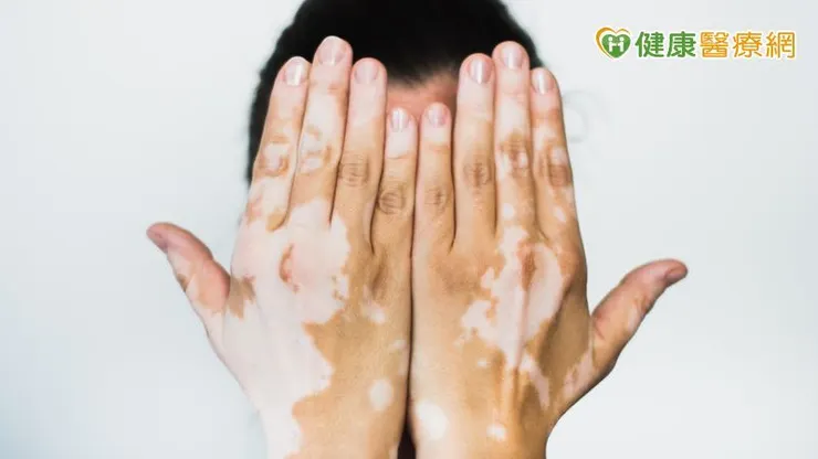 許多病友在面對外界眼光時，容易產生壓力與不安，甚至影響日常生活與人際關係。因此，除了疾病本身的治療外，社會支持與正確認知同樣重要。