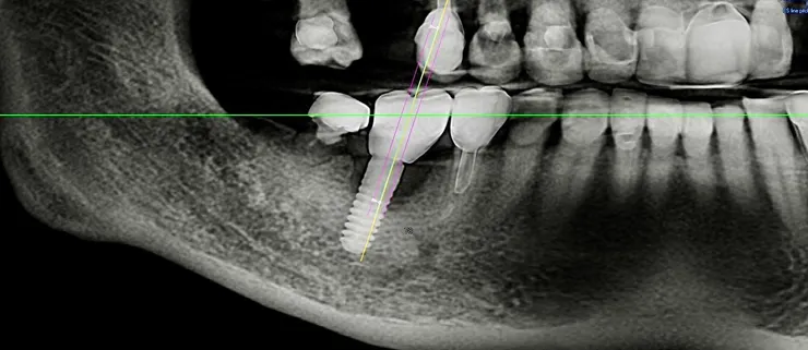 渥爾牙醫診所：植牙不只要穩，更要懂得「避震」！認識Bio-HPP新材料植體假牙