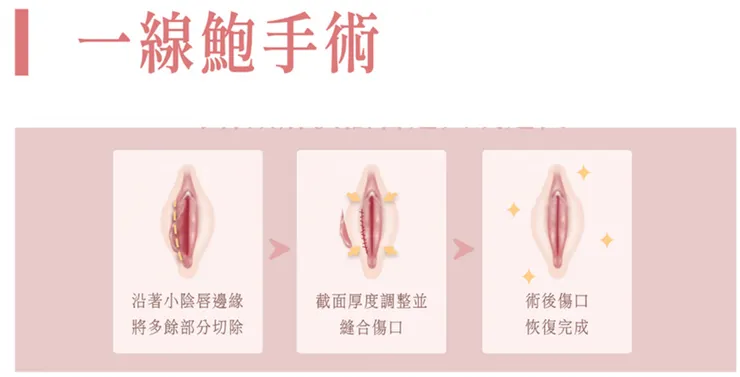 一線鮑手術的流程步驟，第一步切除小陰唇，然後縫合傷口。