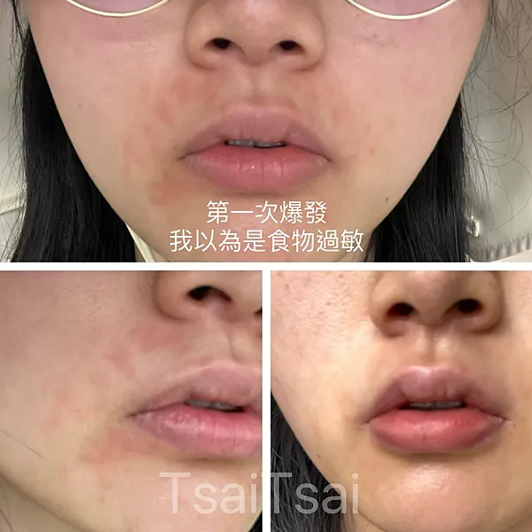 脂漏性皮膚炎症狀脫皮、泛紅