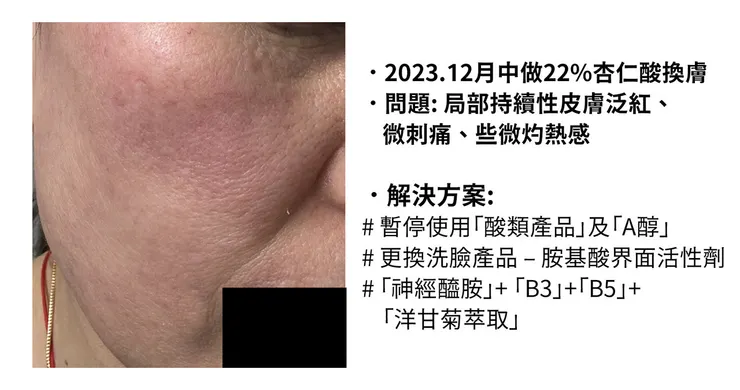 敏感肌怎麼洗臉？