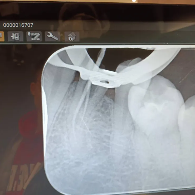 兩根根管的樣子