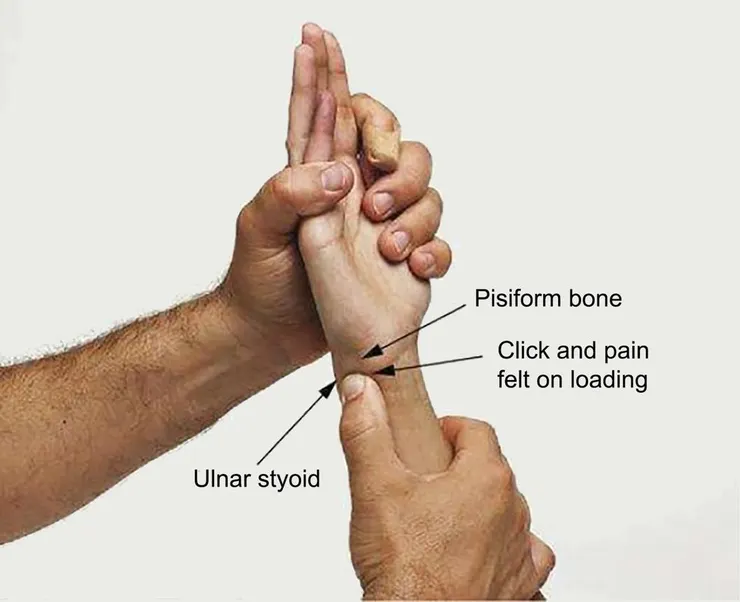 Ulnar Fovea Sign