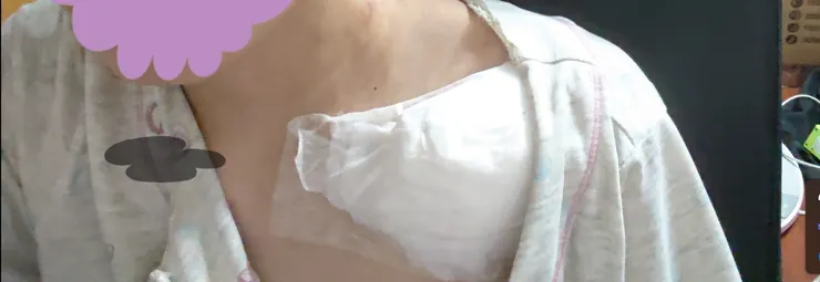 2019剛裝上人工血管