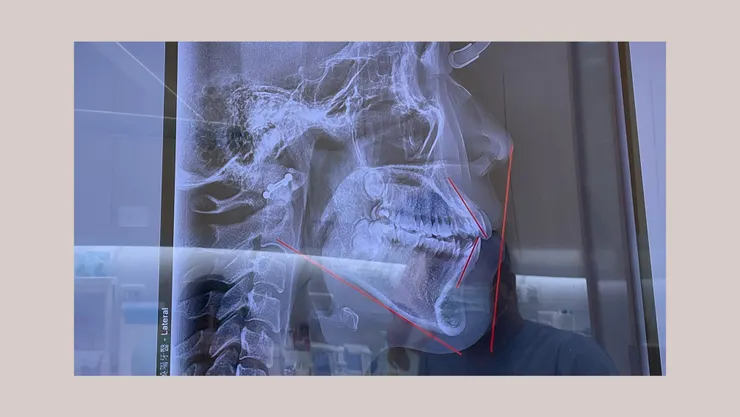 X 光側面照，雖然咬合沒有太大問題，但要自然閉合嘴巴需要出一些力氣