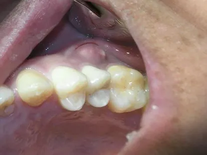 渥爾牙醫診所：小臼齒裂牙不拔牙，Cap-Lock全瓷修復保住原牙！