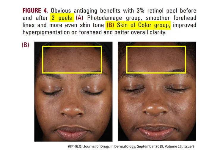 「A醇」現代抗老神器！