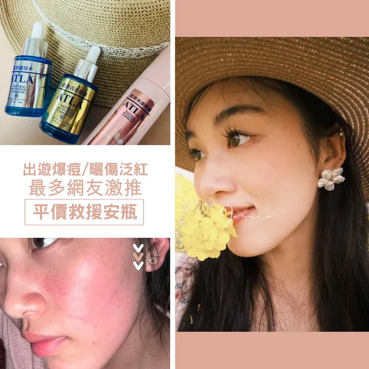 暑假出遊怕爆痘和曬傷！敏感肌激推~「平價救援安瓶」3步驟看完秒懂