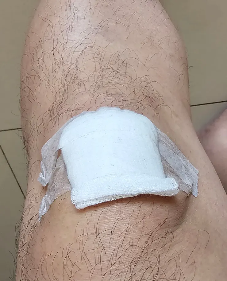 我左邊膝蓋擦傷流血!敏盛醫院護理師幫我包紮!