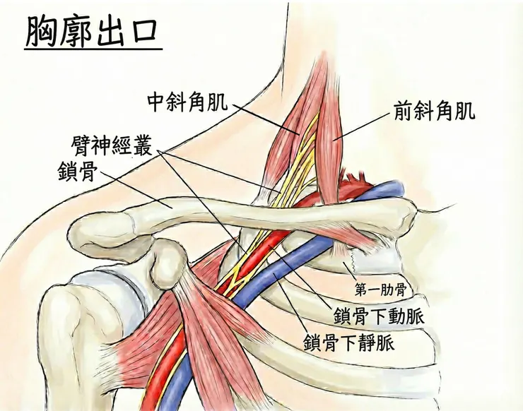 胸廓出口並非真正的「出口」，而是指神經血管從頸部通過鎖骨下方向下延伸至腋窩的區域，常見壓迫位置為前斜角肌與中斜角肌間、鎖骨下空間、胸小肌下空間