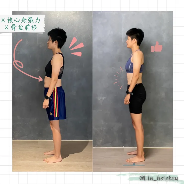 烏龜脖改善案例