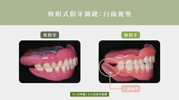 吸附式假牙關鍵:臼齒後墊