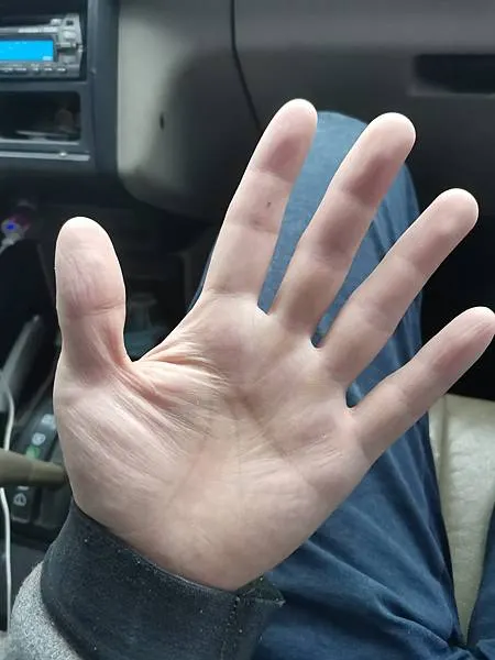 從手掌紋理如可見的筋膜