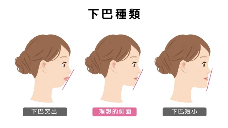 下巴種類