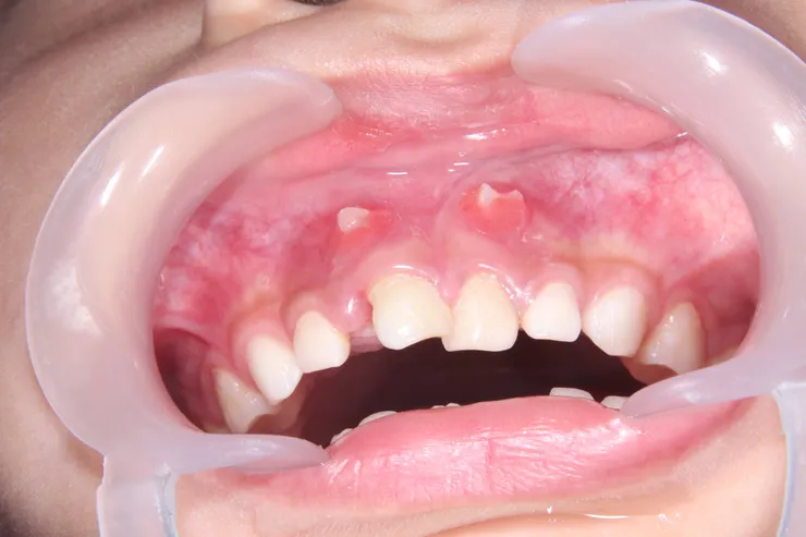 初診時的上乳門牙