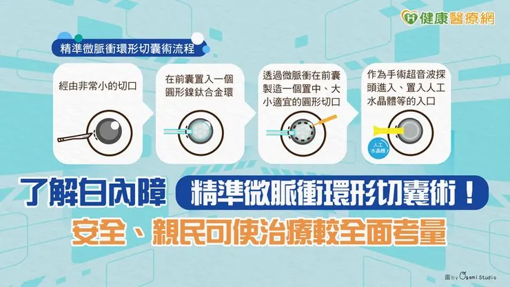 透過手術將白內障患者混濁的水晶體從囊袋中移除，並置入適當的人工水晶體可改善患者視力問題，在手術過程中「前囊撕除」是相當重要的步驟。