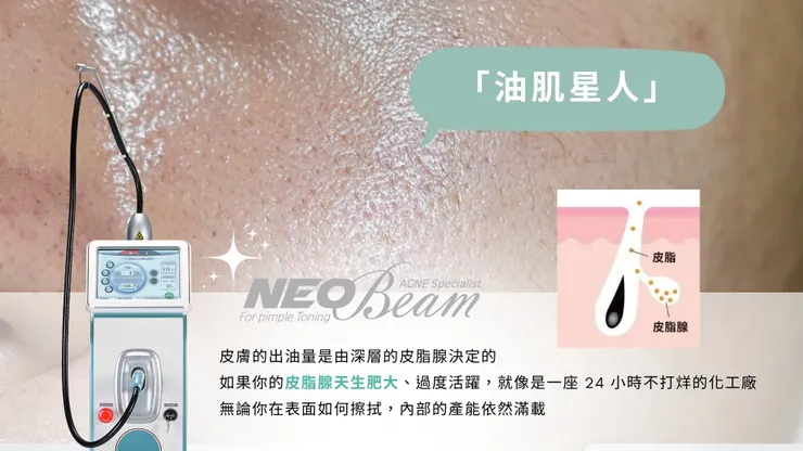 【控油新境界】油光滿面怎麼辦？Neobeam 清新光：從根源縮小皮脂腺的黑科技