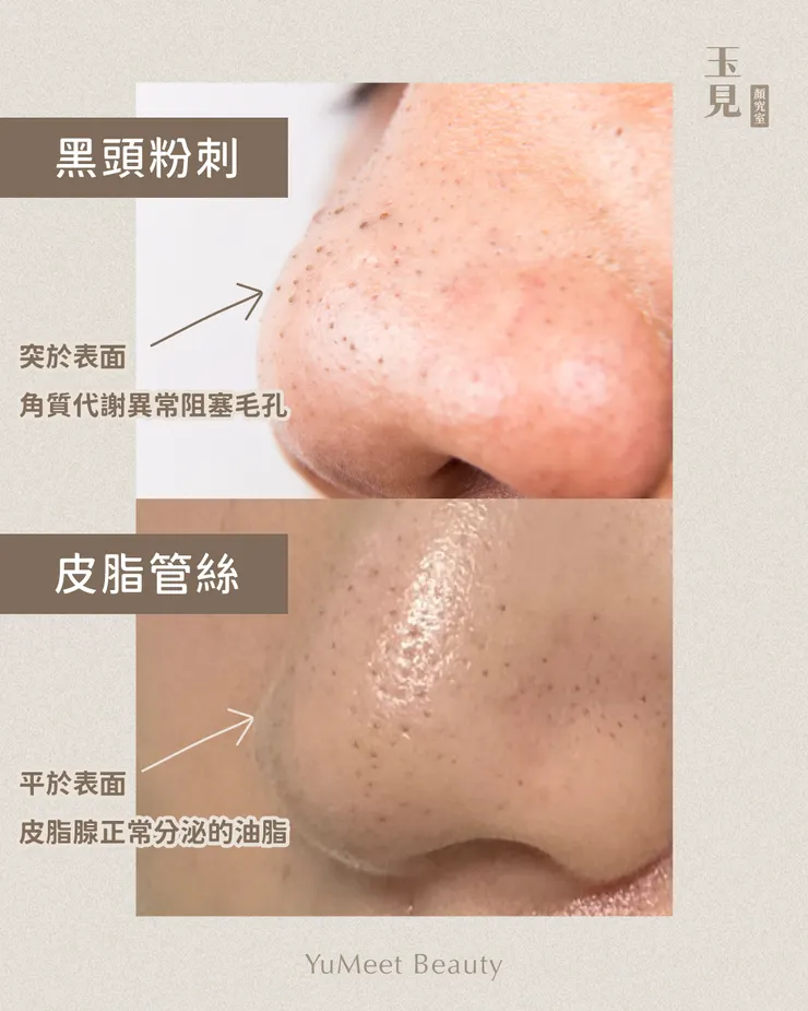 皮脂管絲vs黑頭粉刺