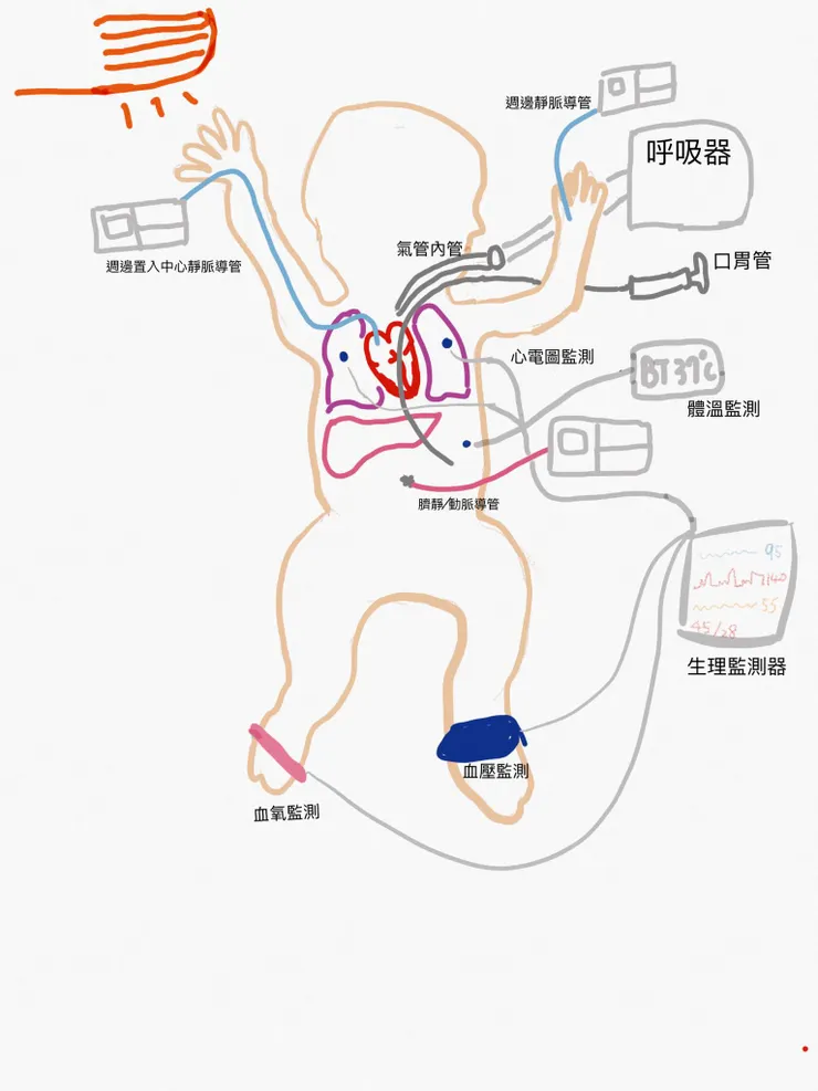 早產兒常見置入的管路