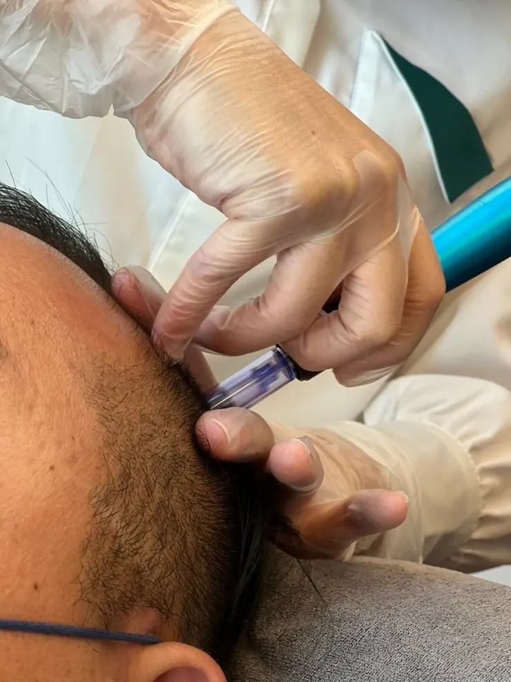 台南美容課程【柔星國際美容教育】毛母開通外泌體御髮教學│養髮