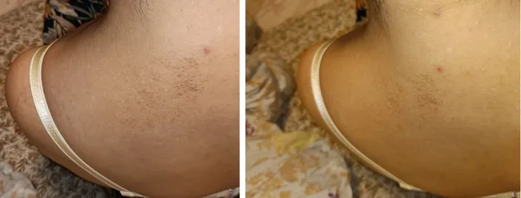 有吃藥 再 擦藥用乳液 還有請要洗澡洗乾淨，改善很多~