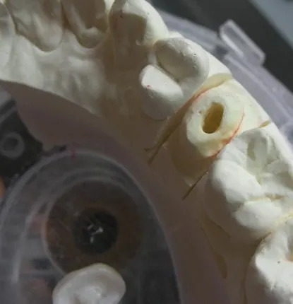 渥爾牙醫診所：小臼齒裂牙不拔牙，Cap-Lock全瓷修復保住原牙！