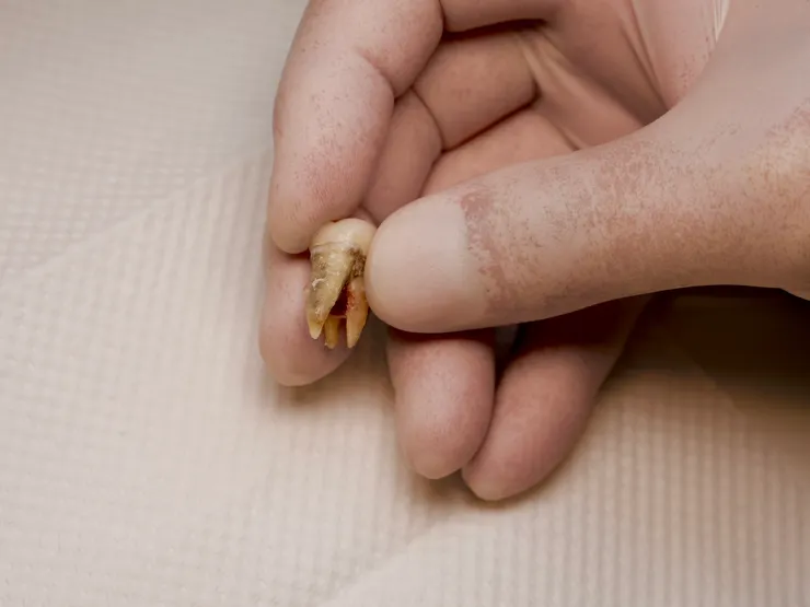 渥爾牙醫提醒！氧化鋯牙冠雖然很硬，但你還是不能亂咬！