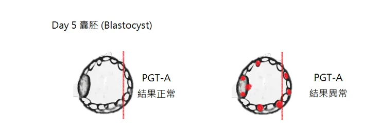 紅色是異常染色體的細胞，PGT-A切下4~5顆細胞，進行PGT-A實驗。