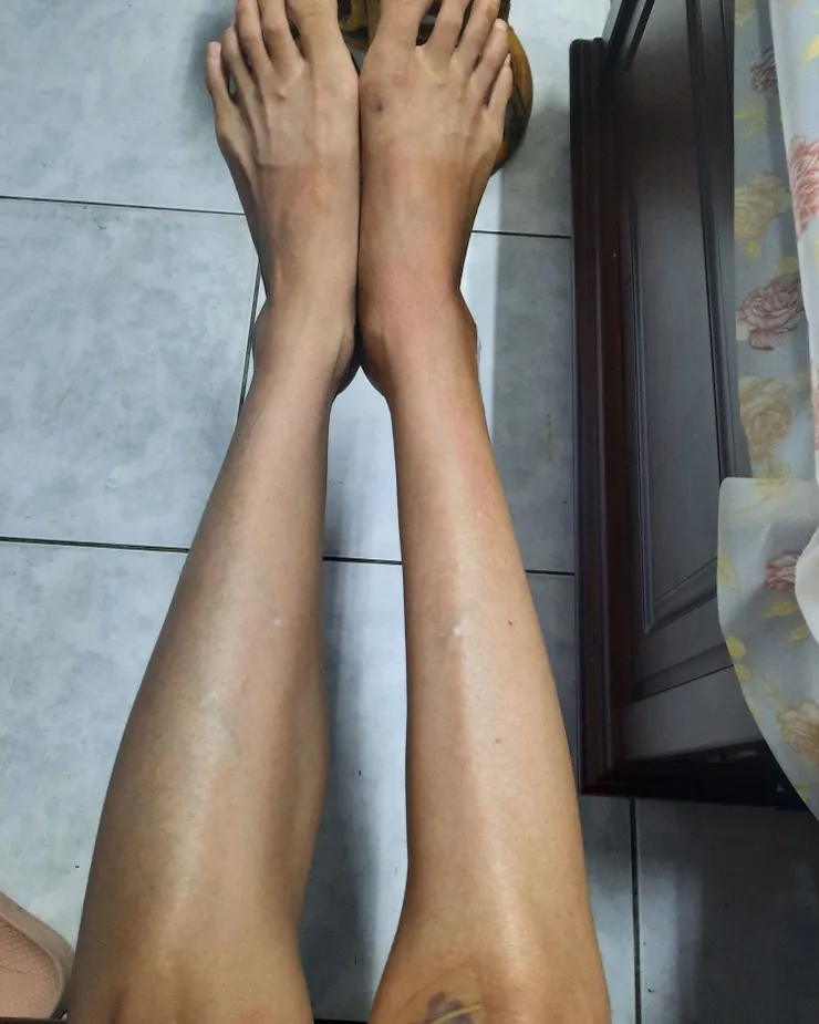 40天了,明顯右肌肉不見了