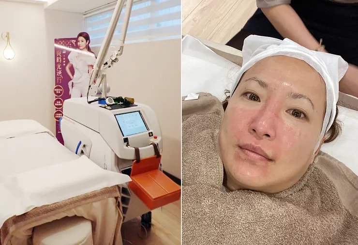 台北打皮秒│探索皮秒+蜂巢(超級鏡片ReFIX)-台北醫美診所推薦