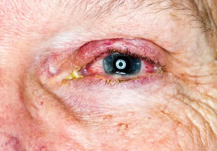 白黴菌病— PHARMATUTOR