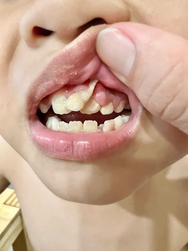8個月後,右上乳門牙已經自己掉了,剩越來越歪的左上乳門牙(家長照相提供),後來去給住家附近的牙醫師拔掉了