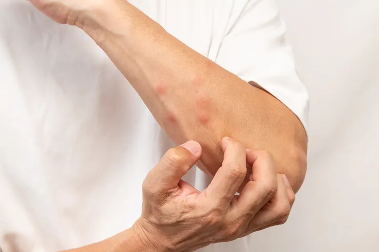 防小黑蚊咬懶人包