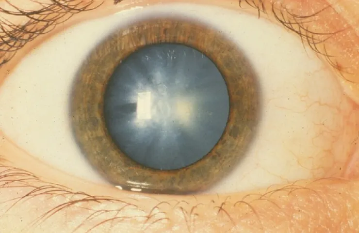 steroid induced cataract-Stlpr