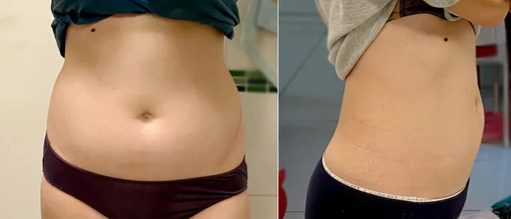 3.0特斯拉「太能波AES」懶人體雕,超越健身極限的深層肌肉鍛鍊,新莊愛爾麗!