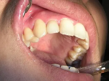 渥爾牙醫診所：Cap-Lock全瓷牙冠安裝，回診、追蹤！