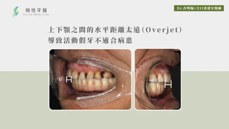 水平覆蓋咬合(Overjet)