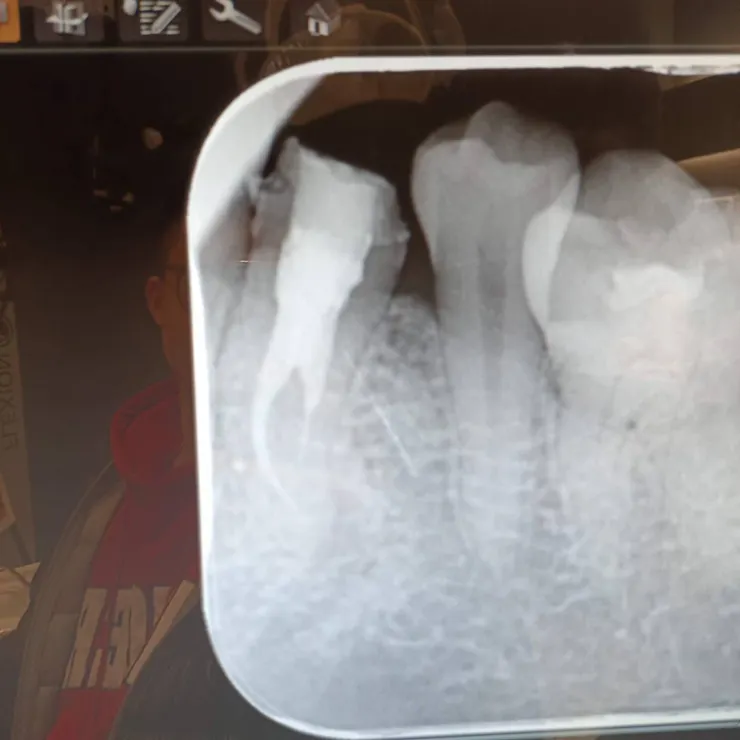 根管被填起來的樣子