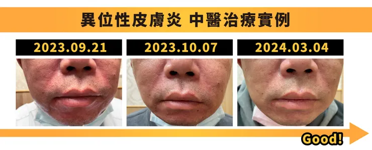 脂漏性皮膚炎中醫治療實例