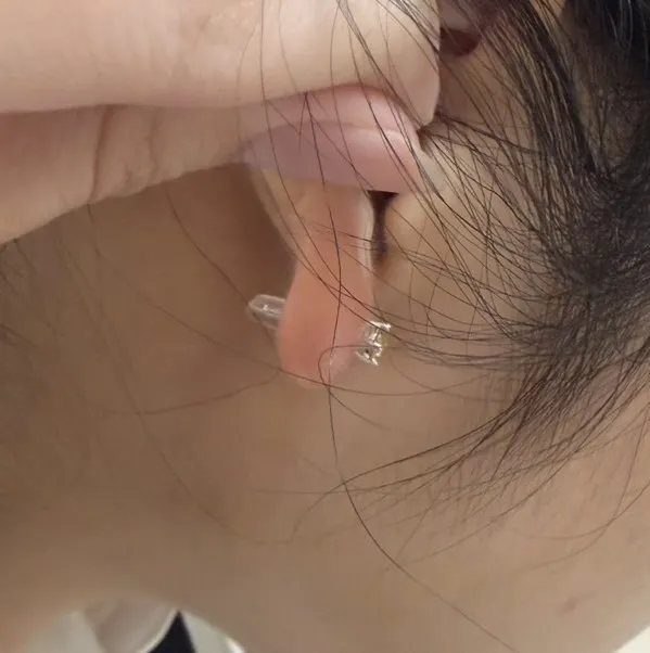 自己換耳墊之後，發炎腫脹