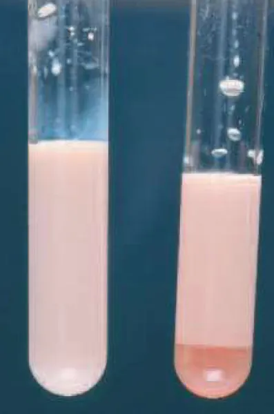 左邊是高血脂症後禁食後的血清，右邊是冷藏後上面呈現白色奶油狀物質是乳糜微粒，但下面仍混濁，顯示仍有其他脂蛋白在內。