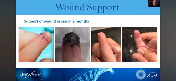 使用X39 兩個月的成果 (原本醫生預估需要9個月的時間才能復原)