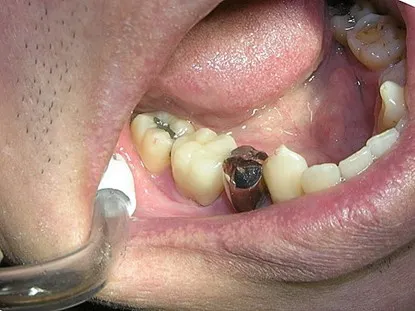 渥爾牙醫診所: Cap-Lock全瓷系列修復案例!斜裂下大臼齒的成功修復!