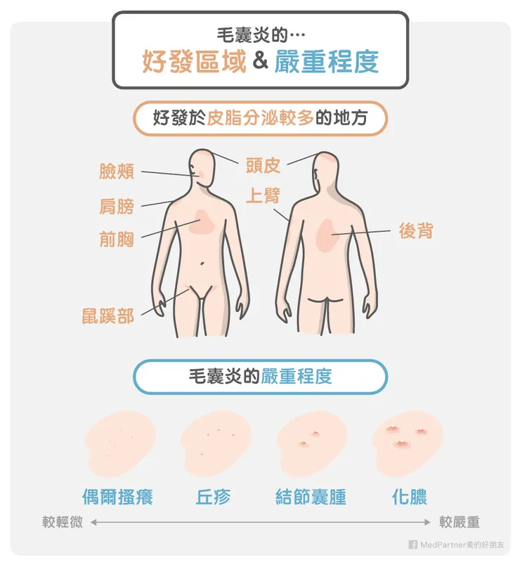 毛囊炎的病徵與好發部位