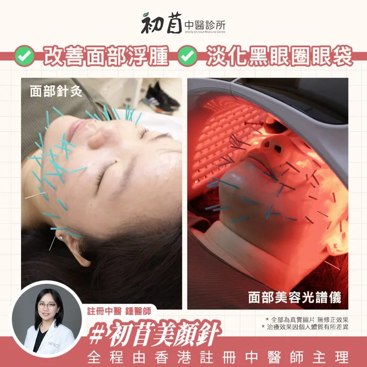 中醫美顏針 , 面部針灸 , 25歲後我開始容貌焦慮