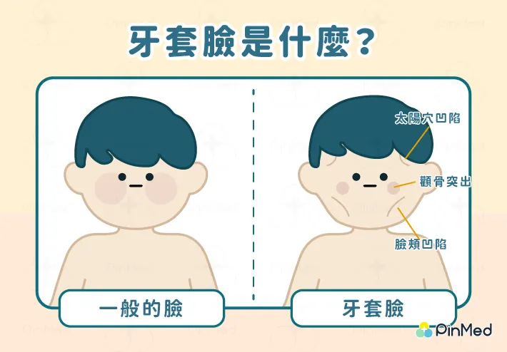 牙套臉是什麼？