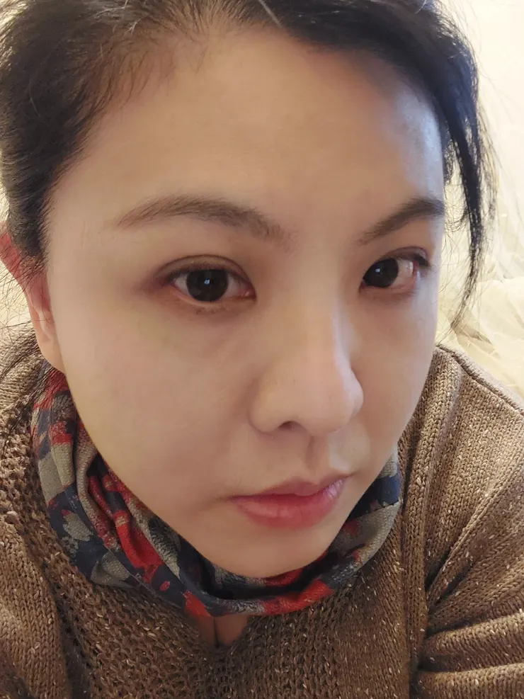 沒睡好，有點眼袋、淚溝